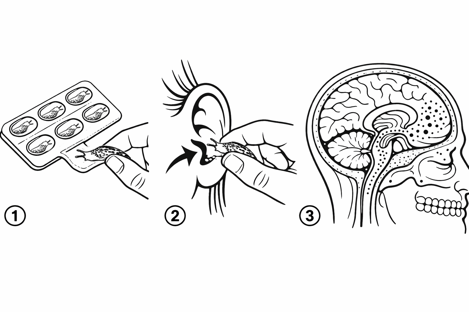 Schematische Anleitung zur Anwendung von Altruon mit drei Schritten: Entnahme aus der Verpackung, Einführen in den Gehörgang, Freisetzung des Wirkstoffs Richtung Gehirn.